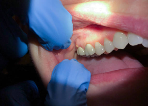 Best Emergency Tooth Extraction in Topeka, IN